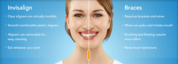 Invisalign clear braces vs regular metal braces in Alexandria, VA