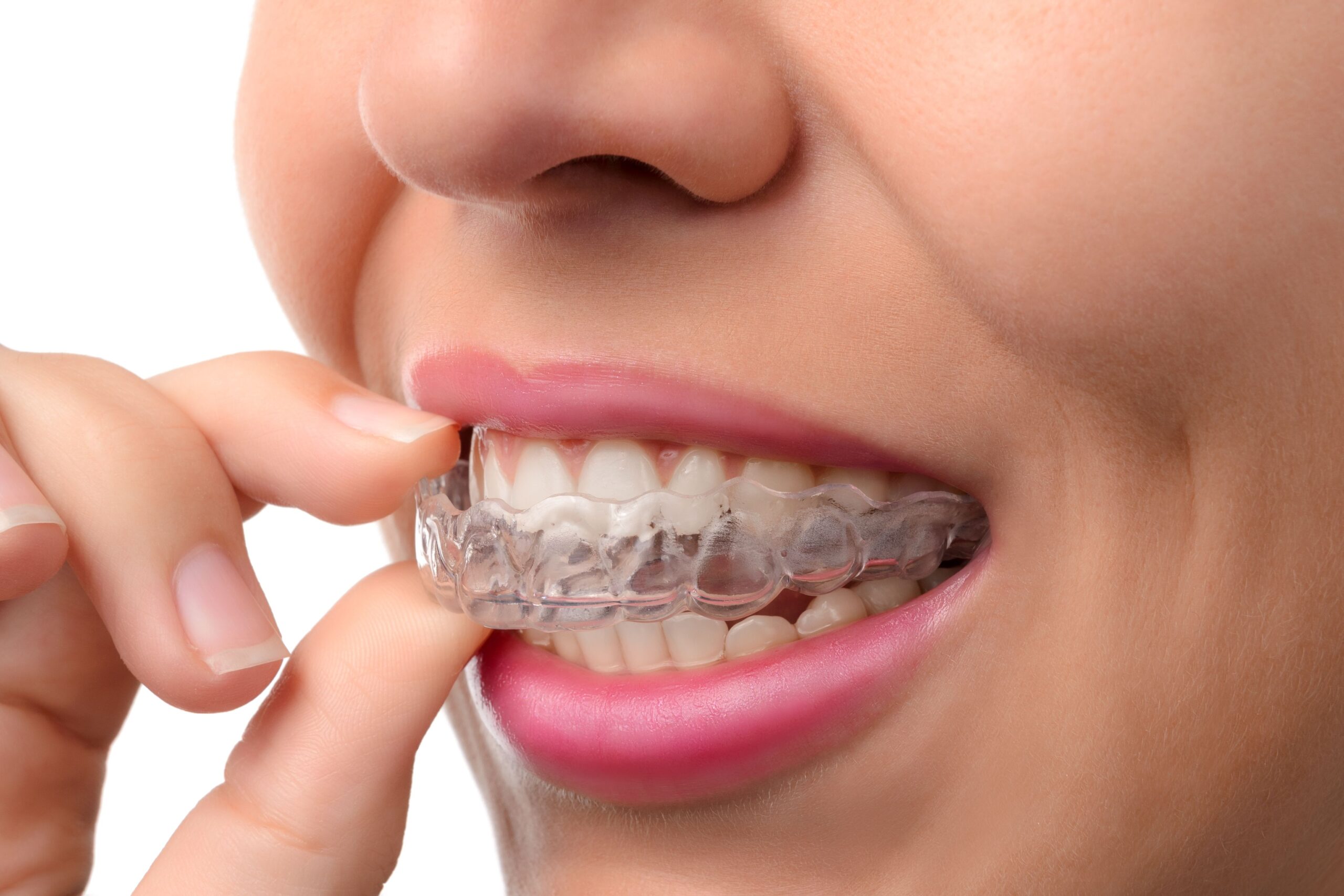 An invisable aligner being inserted.