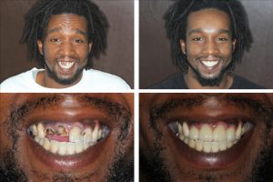 Before and after cosmetic dentistry in Alexandria VA