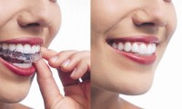 Invisalign for Mt Vernon