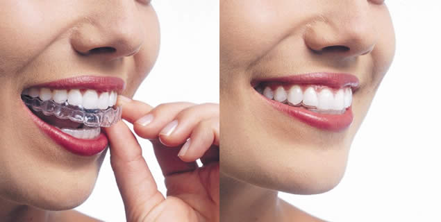 Invisalign Clear Braces For Alexandria Invisible Braces Mt Vernon Mt Vernon Center For Dentistry Alexandria Dentist