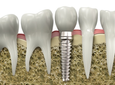 A graphic image of a successful dental implant treatment in Alexandria.