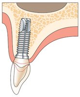 dental implant dentistry for Alexandria and Mt Vernon