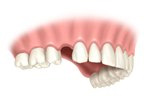 implant implant