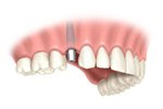 implant implant