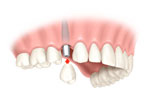 implant implant