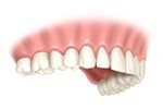 implant implant