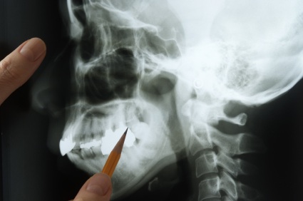 A jawbone being examined by a dentist during an emergency evaluation in Alexandria.