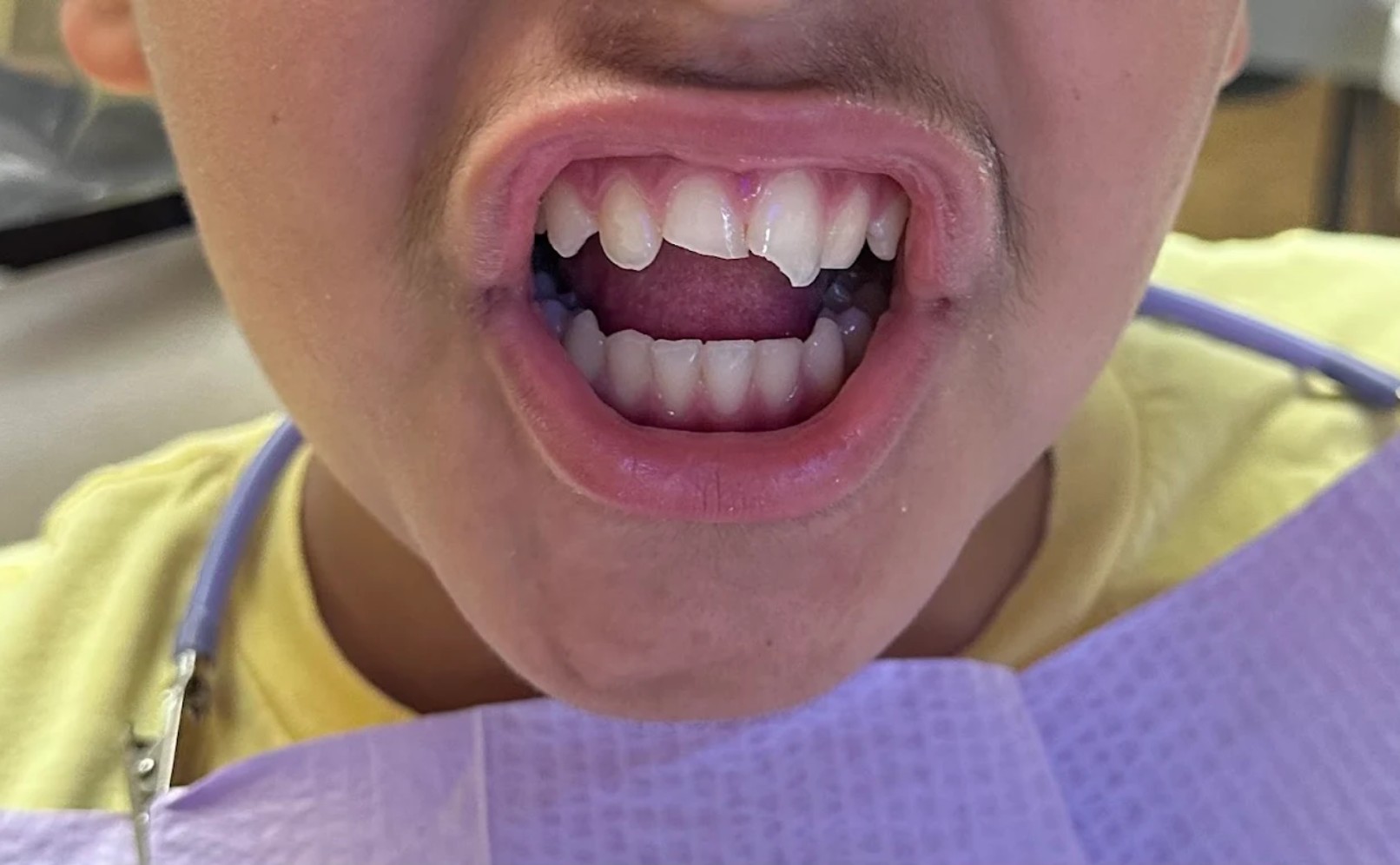 A patient with damaged teeth getting treatment in Alexandria.