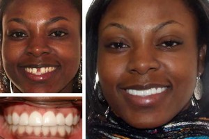 Before and after visiting Alexandria dentist Dr. Geren