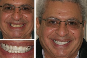 Alexandria patient before and after photos with Dr. Geren