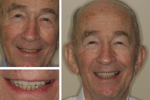 Alexandria dentist patient before and after photos