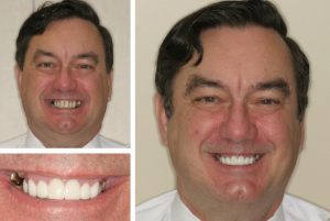 Alexandria dentist near me patient before and after photos