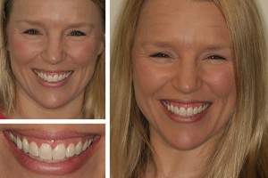 Dr. Geren Alexandria dentist before and after photos