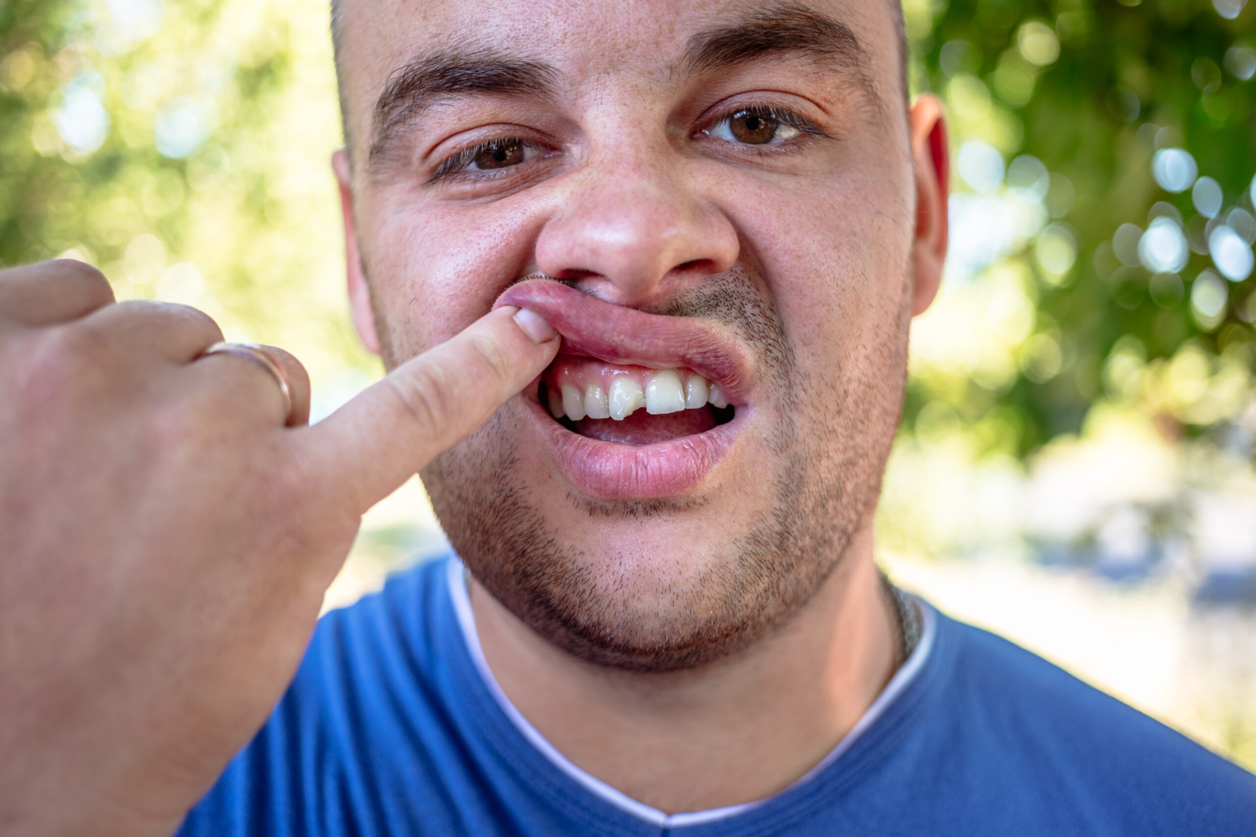 Young man in a blue T-shirt with a chipped tooth