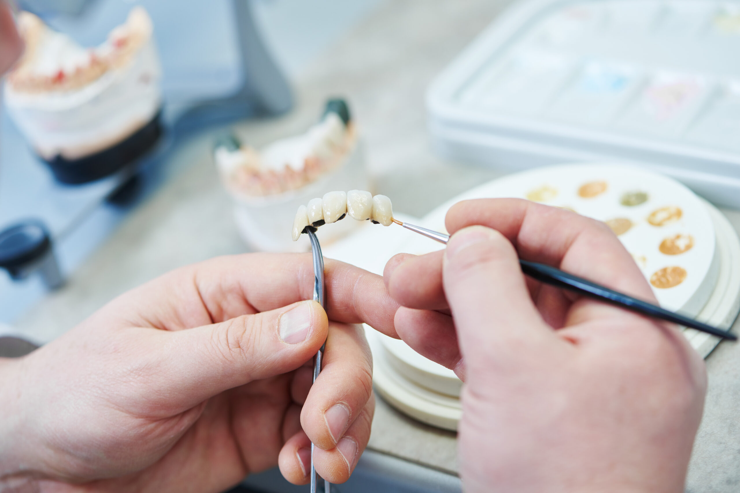 up-close dental bridge